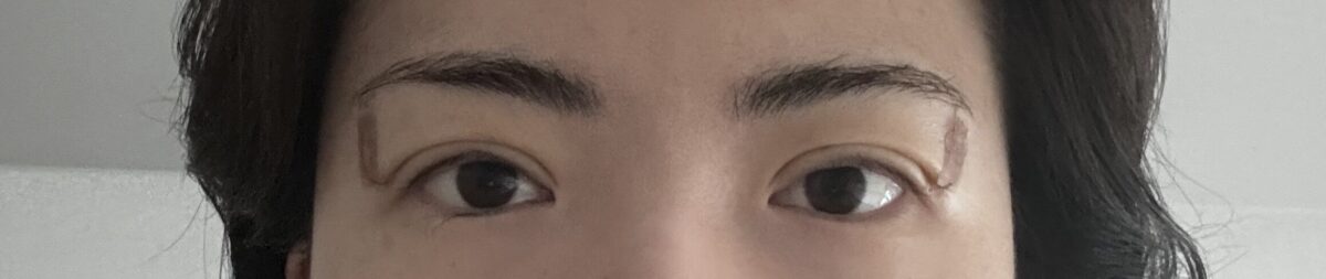 การผ่าตัดแก้ไขดวงตา (การยึดติดตามธรรมชาติ)