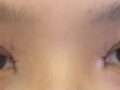 การยึดเกาะตามธรรมชาติ + การผ่าตัดตกแต่งหัวตา