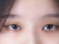 รีวิวการยกกระชับเปลือกตาบนด้วยวิธี Natural Adhesion ของคุณหมอคิม