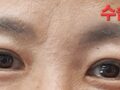 全切双眼皮手术(50多岁）