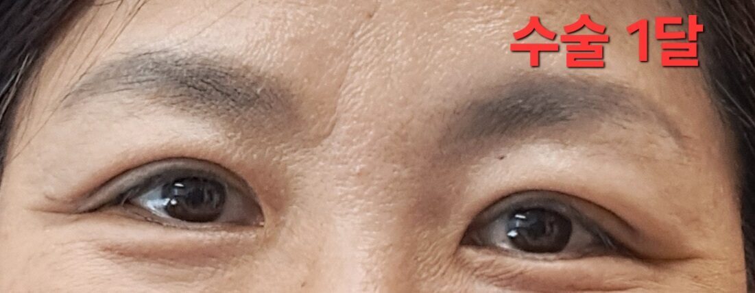 全切双眼皮手术(50多岁）