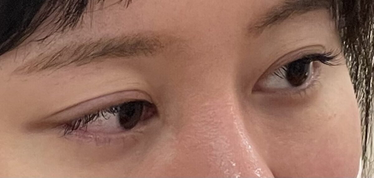 自然癒着3ヶ月