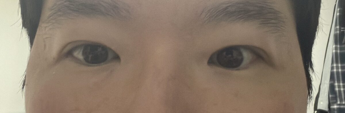 全切双眼皮+提肌+上眼角  1个月 术后反馈