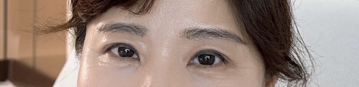 埋线双眼皮  术后反馈