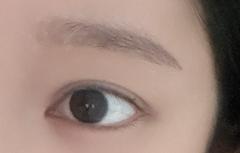 รีวิวการผ่าตัดยกกระชับเปลือกตาบนด้วยวิธีธรรมชาติครั้งแรก!!!