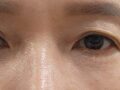 眼底脂肪重排  术后反馈