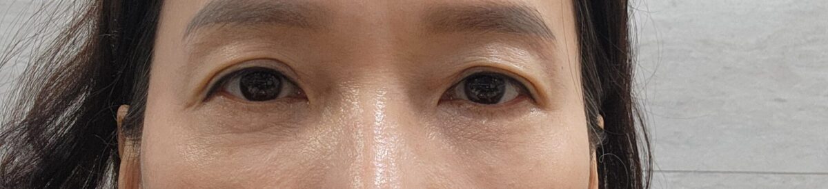 眼底脂肪重排  术后反馈