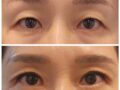 Phẫu thuật thẩm mỹ không xâm lấn + Chỉnh sửa mí mắt