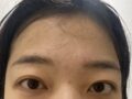 อิลมิริ / ผู้กำกับ คิม ฮงจิน / การปรับตำแหน่งไขมันใต้ตา