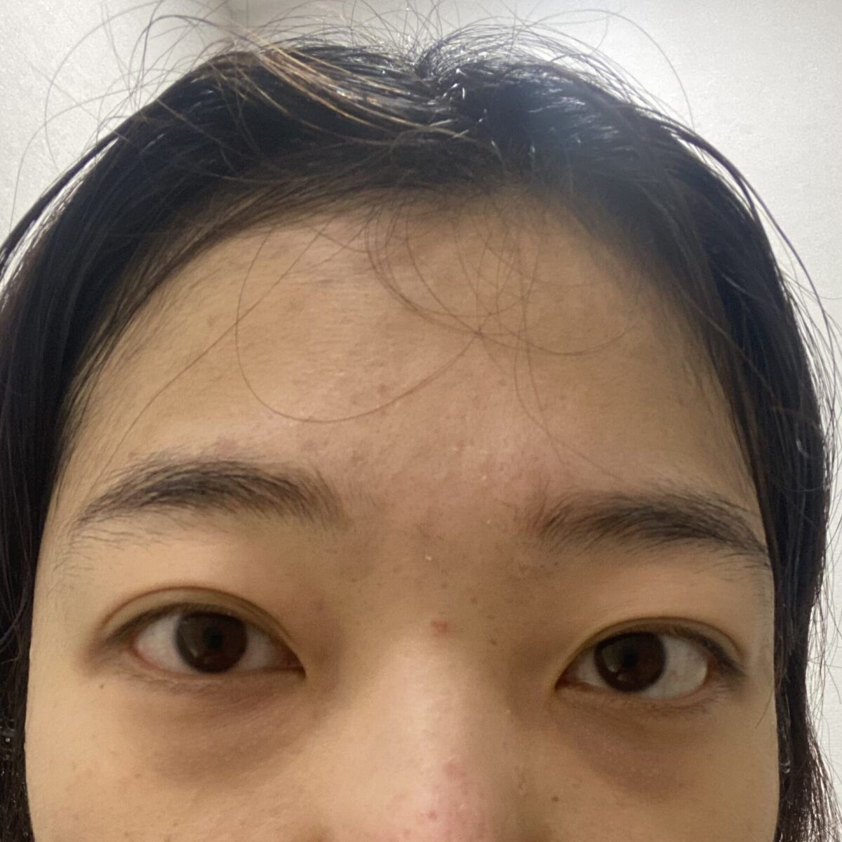 一毫米  金洪振院长-眼底脂肪重排