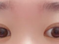 การยกกระชับเปลือกตาบน + การแก้ไขเปลือกตา + แบบไม่ผ่าตัด โดย ดร. คิม ฮงจิน