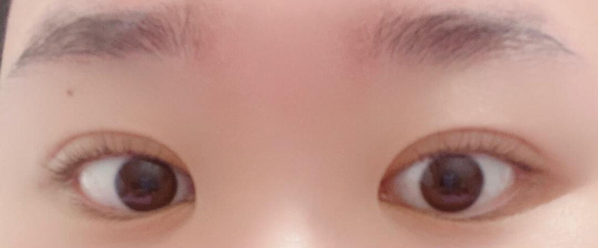 การยกกระชับเปลือกตาบน + การแก้ไขเปลือกตา + แบบไม่ผ่าตัด โดย ดร. คิม ฮงจิน