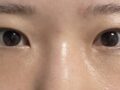 埋线双眼皮,提肌+眼底脂肪重排   -   金洪振院长