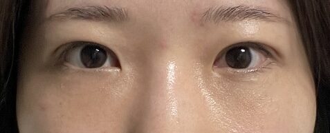 การแก้ไขเปลือกตาโดยไม่ต้องผ่าตัด + การจัดตำแหน่งไขมันใต้ตาใหม่ - ผู้กำกับ คิม ฮงจิน