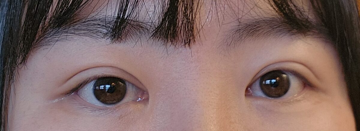 全切双眼皮+提肌  修复