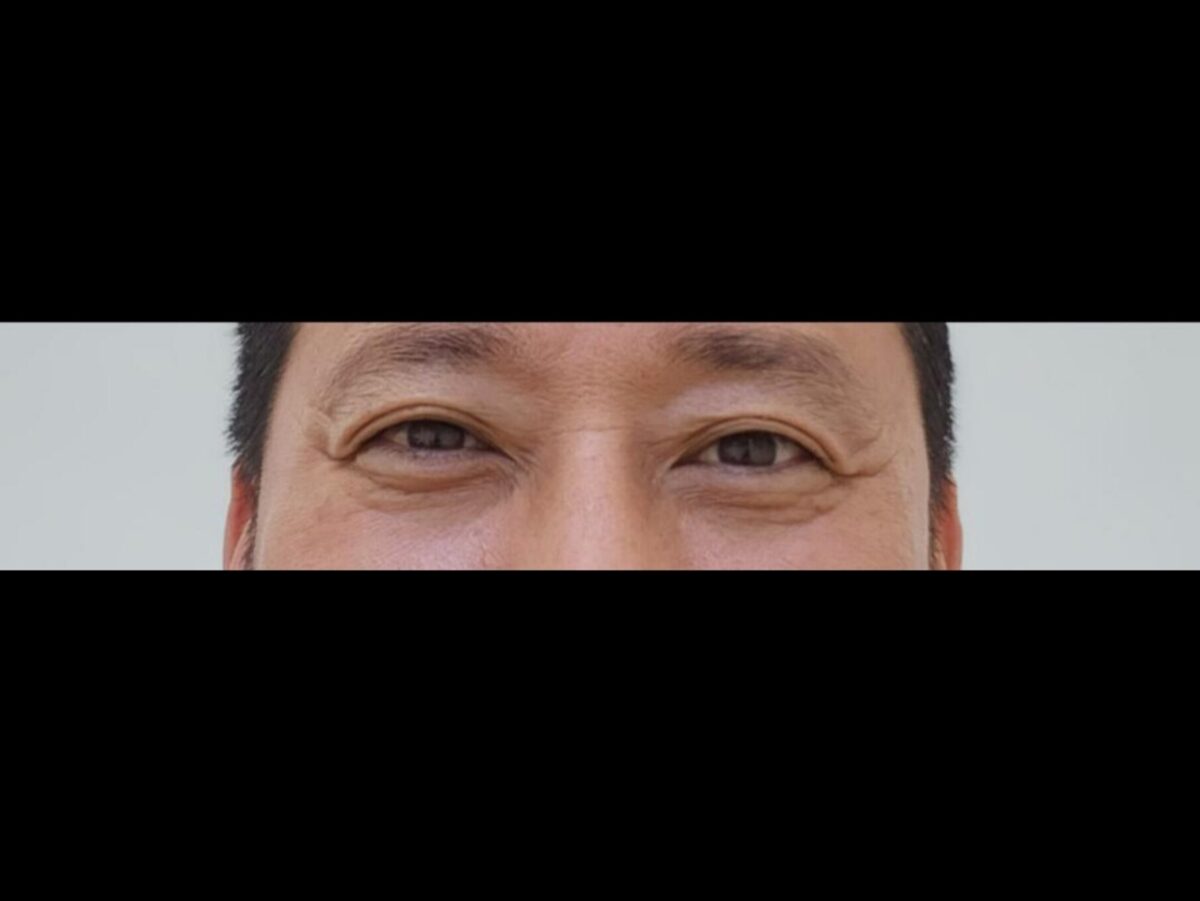 金洪振院长 上眼睑手术 术后反馈
