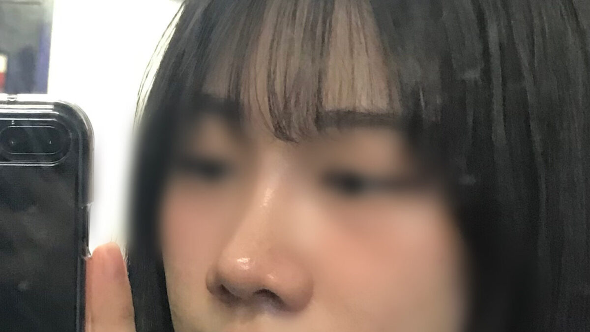 这是我隆鼻手术的反馈