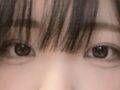 双眼皮+上眼角  术后反馈