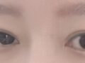 一毫米 都彦禄院长做的双眼皮提肌是最棒的！