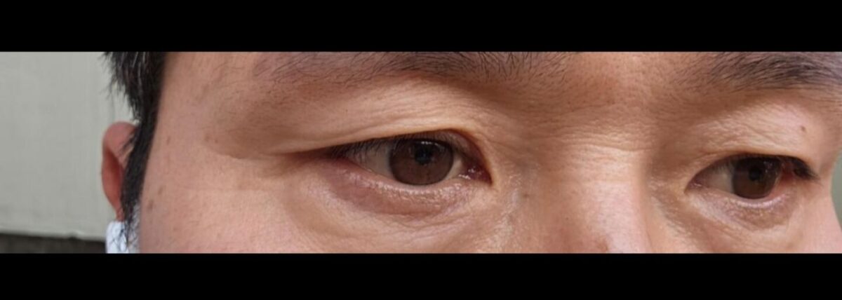 การผ่าตัดทำตาสองชั้นของผู้อำนวยการโด