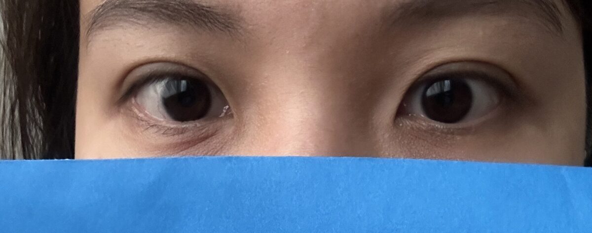 自然粘连埋线双眼皮  术后2个月  （金洪振院长）