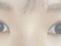 ฉันเข้ารับการผ่าตัดแก้ไขสายตาโดยผู้กำกับคิม ฮงจิน