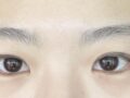 金洪振院长  双眼皮术后2个月 反馈