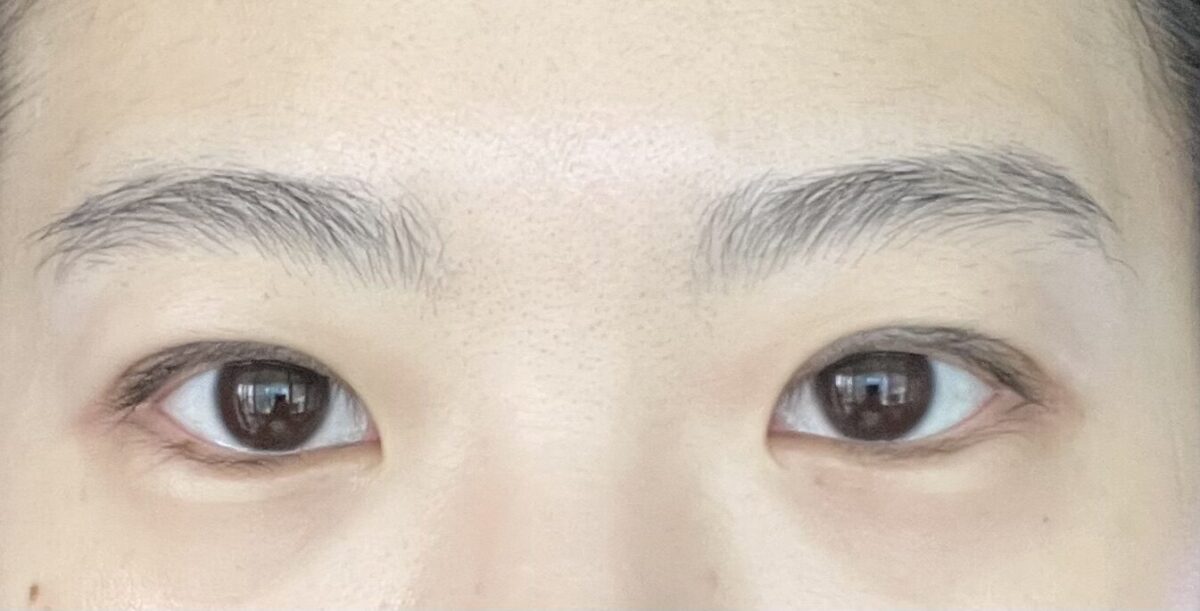 金洪振院长  双眼皮术后2个月 反馈