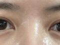 รีวิวการผ่าตัดตกแต่งเปลือกตาบนด้วยวิธีธรรมชาติ โดยผู้กำกับ โด ออน-ร็อก