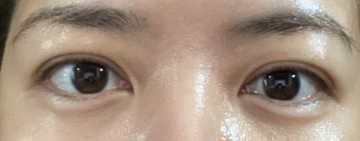 รีวิวการผ่าตัดตกแต่งเปลือกตาบนด้วยวิธีธรรมชาติ โดยผู้กำกับ โด ออน-ร็อก