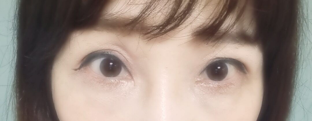 รีวิวการจัดตำแหน่งไขมันใต้ตาใหม่