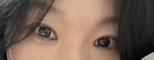 都彦禄院长  全切双眼皮+前眼角+上眼角 术后反馈