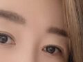 双眼皮修复  术后一个月 反馈