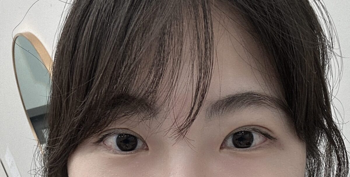 金洪振院长双眼皮手术反馈