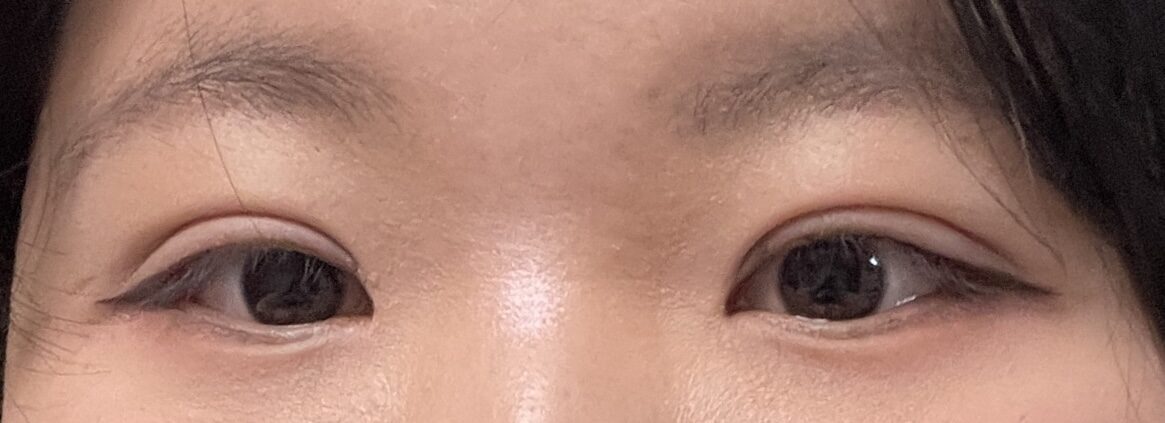 都彦禄院长 术后反馈