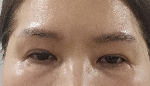 切眉提升 术后反馈