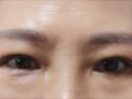 รีวิวการผ่าตัดยกคิ้วและศัลยกรรมตกแต่งเปลือกตาแบบซ่อน (ดร. คิม ฮงจิน)