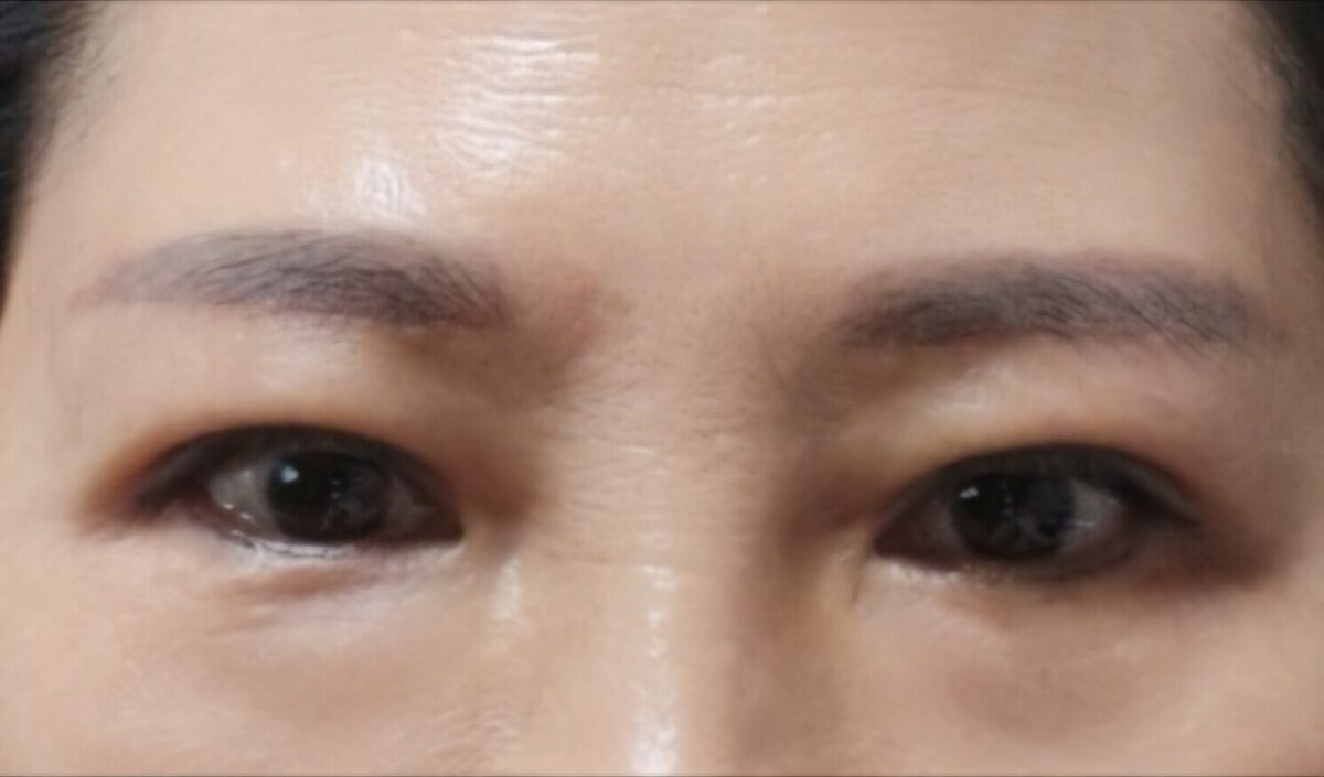 切眉提升+埋线双眼皮  术后反馈  / 金洪振院长