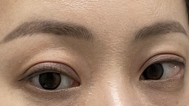 都彦禄院长  埋线双眼皮（修复）