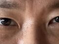 金洪振院长 -  眼底脂肪重排+双眼皮  术后