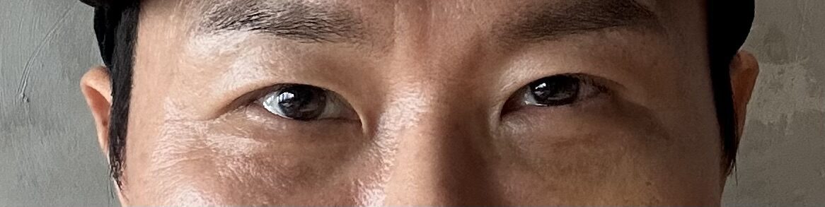 金洪振院长 -  眼底脂肪重排+双眼皮  术后