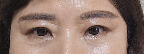 眼部下垂   双眼皮手术  反馈