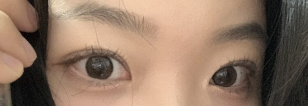 自然粘连 -都彦禄院长  