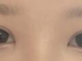 Front and back canthoplasty, non-incisional double eyelid surgery
