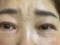 キム・ホンジン院長非切開ペアカップル/眉毛巨像/ハアンガムレビュー
