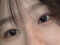 金洪振院长  自然粘连 术后反馈