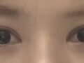 双眼皮修复手术  反馈