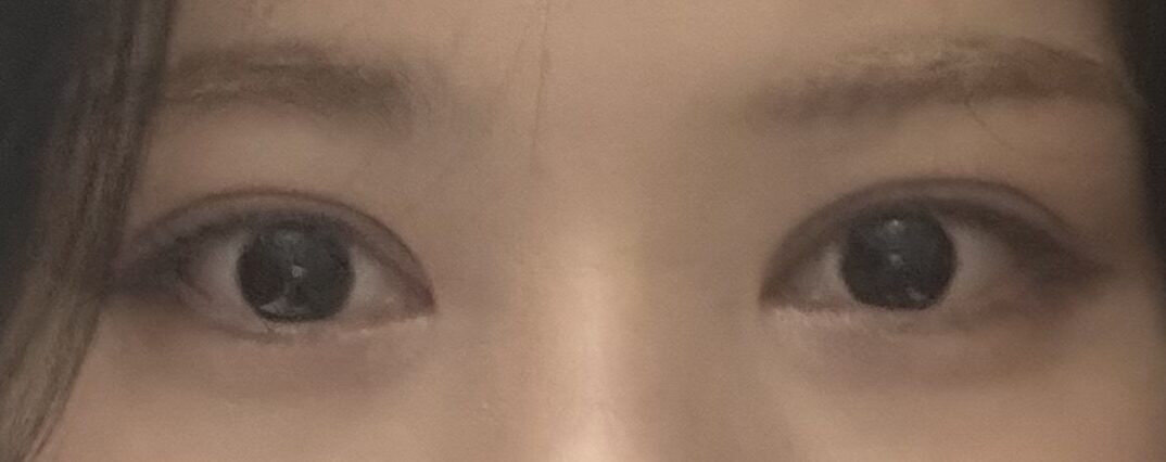 双眼皮修复手术  反馈