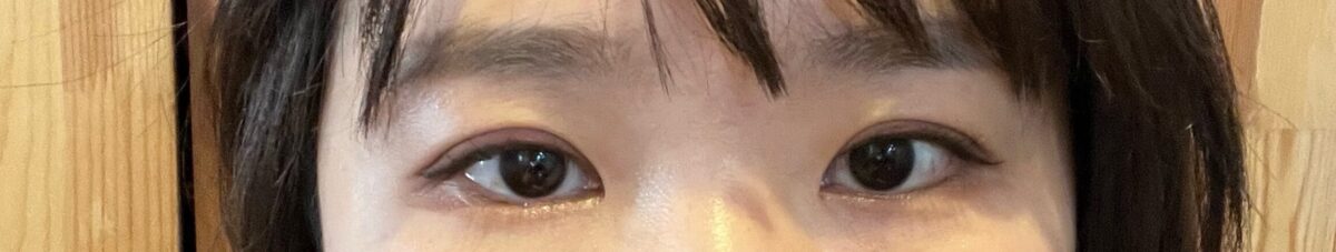 รีวิวการผ่าตัดทำตาสองชั้นแบบกรีด + ยกเปลือกตาบน + แก้ไขเปลือกตา โดยผู้กำกับ โด ออน-ร็อก