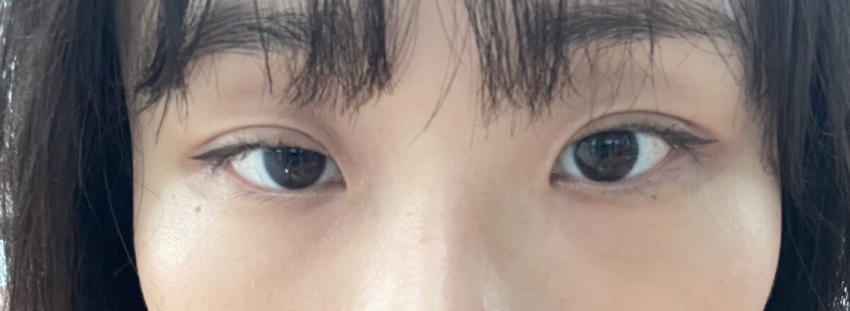 การแก้ไขเปลือกตา (เย็บปิดแผล) ผู้กำกับ โด